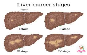 Liver cancer stages