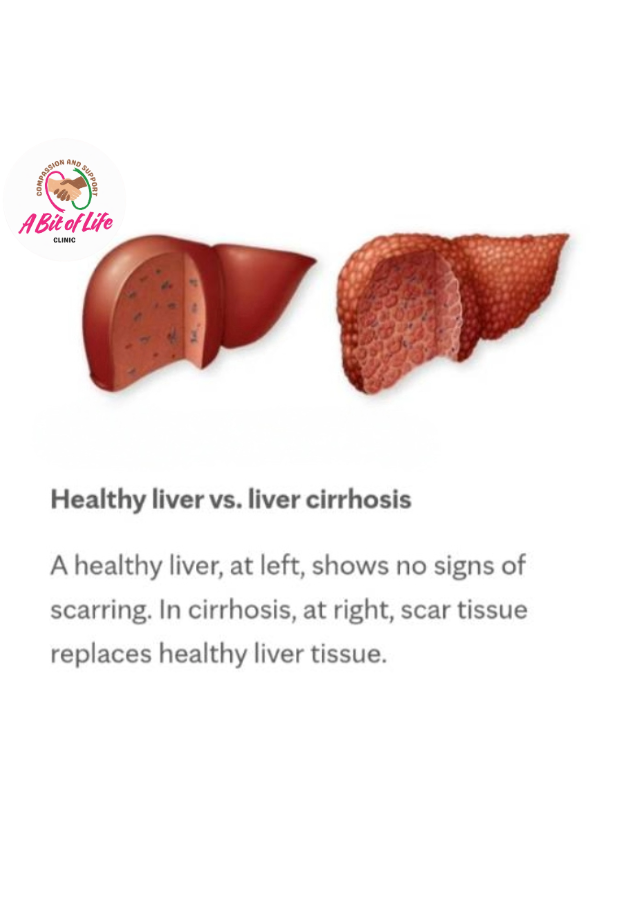 Healthy liver compared with cirrhosis