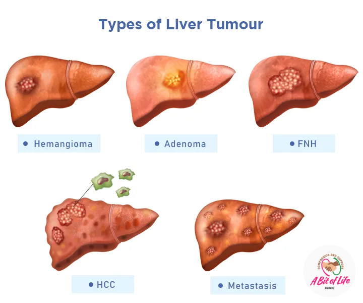 Types of liver tumour