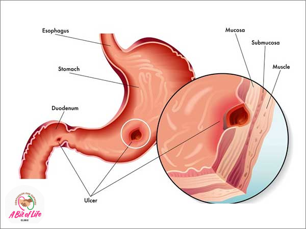 Peptic ulcer diagram