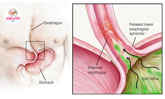 Acid reflux and inflamed oesophagus diagram