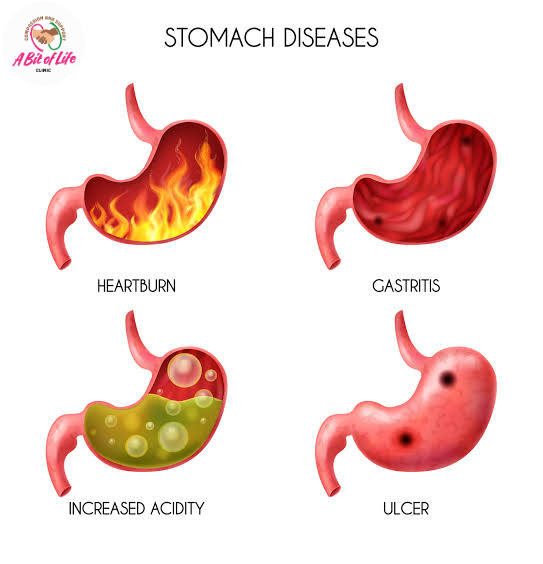 Common stomach conditions