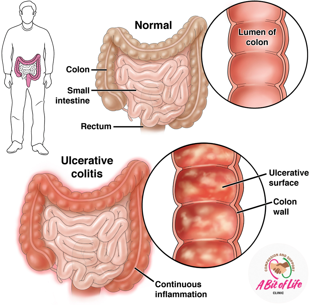 Ulcerative colitis compared to a normal colon